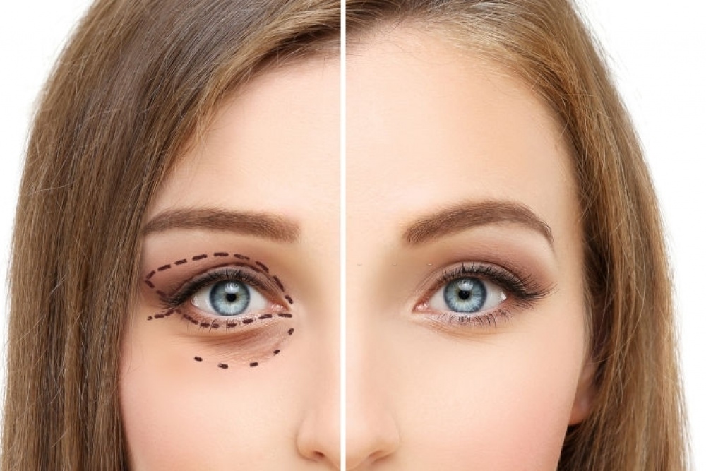 Blefaroplastia, perguntas e respostas sobre a cirurgia de pálpebras