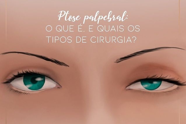 Ptose palpebral